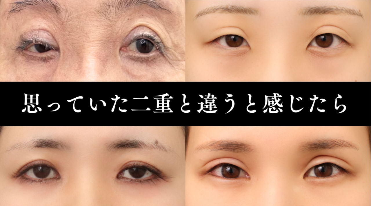 二重全切開・眼瞼下垂の修正