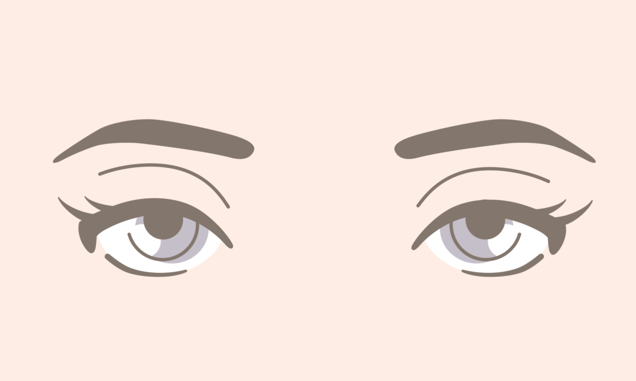 二重全切開・眼瞼下垂の修正