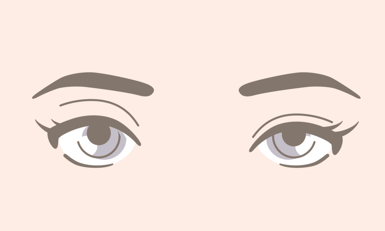 二重全切開・眼瞼下垂の修正