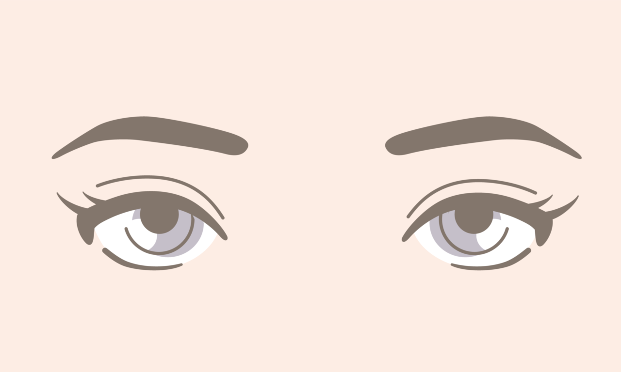 二重全切開・眼瞼下垂の修正