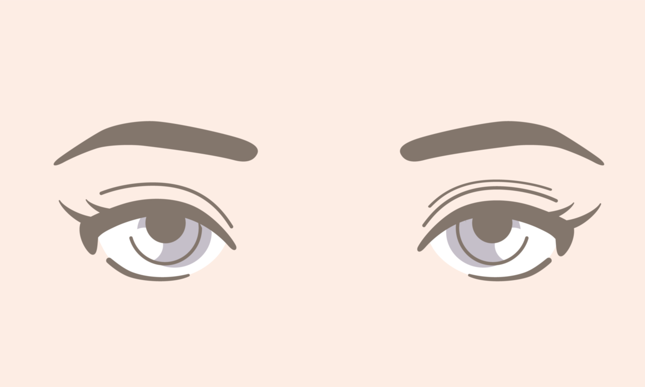 二重全切開・眼瞼下垂の修正