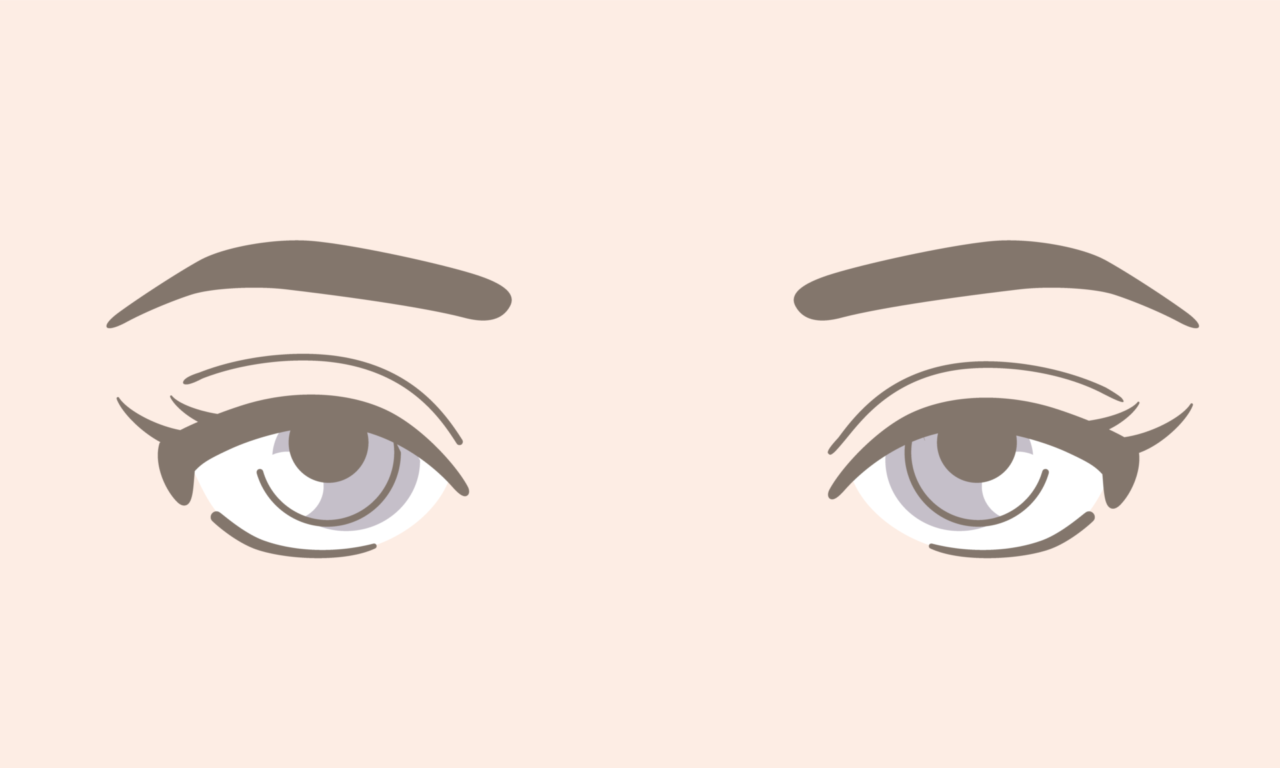 二重全切開・眼瞼下垂の修正