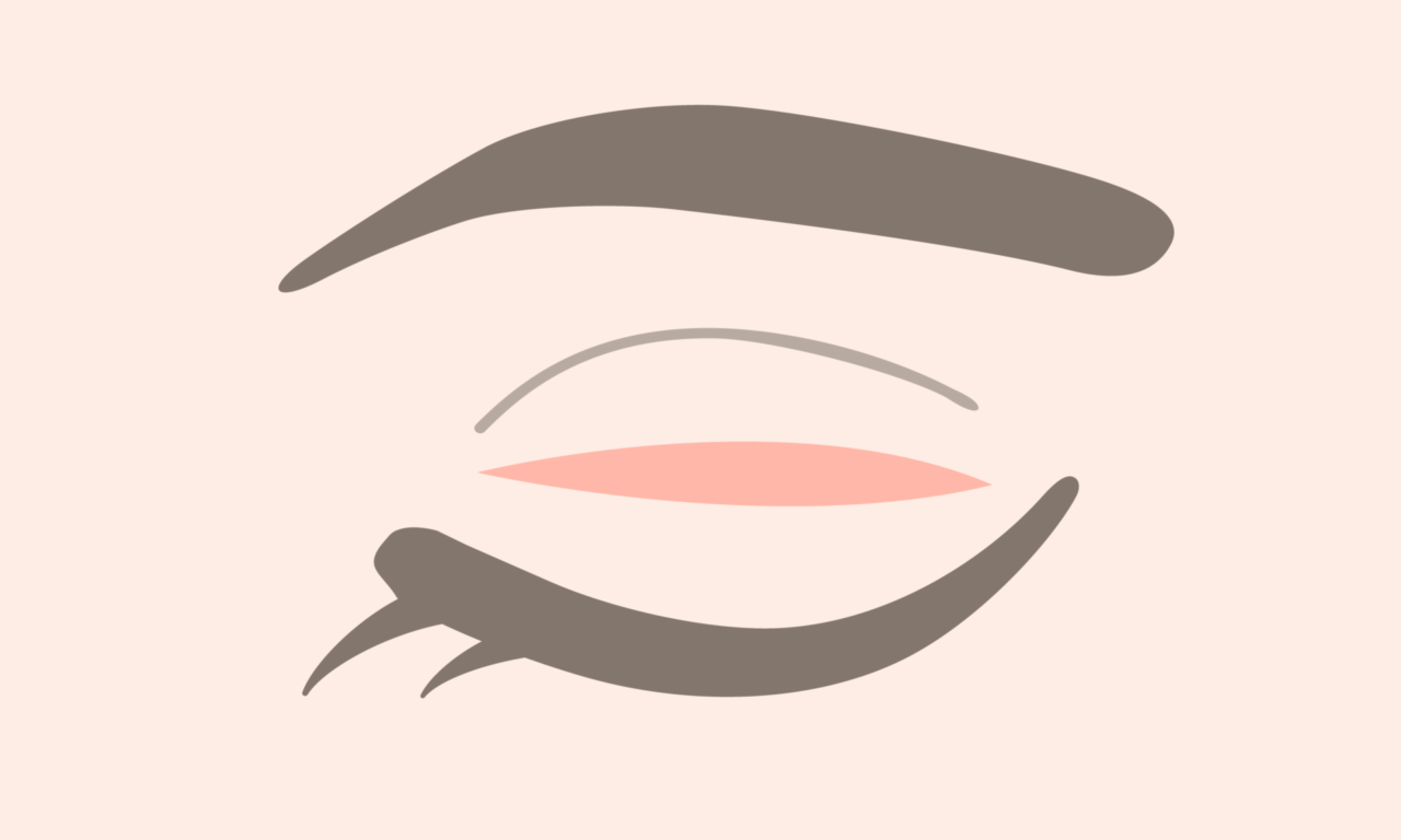 二重全切開・眼瞼下垂の修正