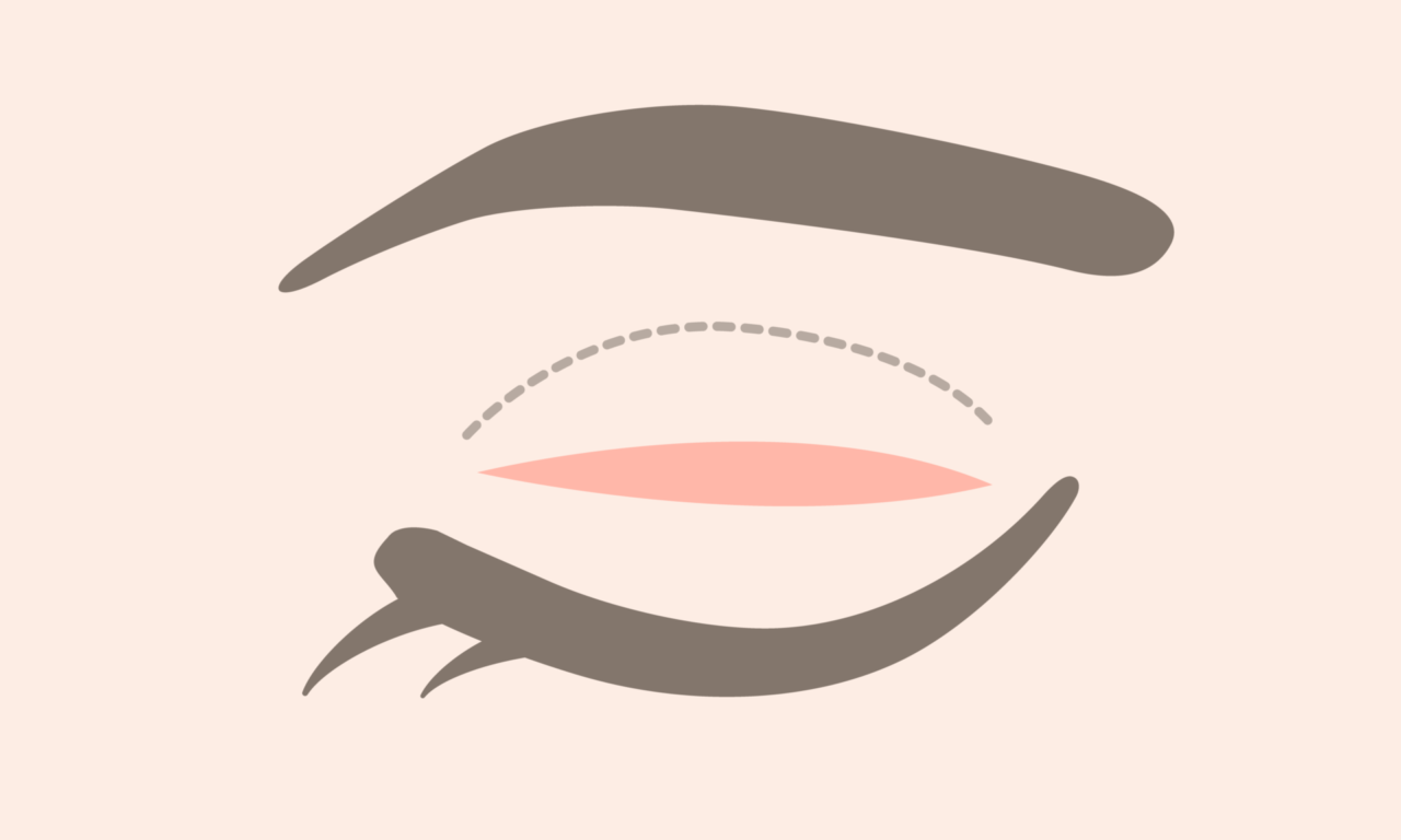 二重全切開・眼瞼下垂の修正