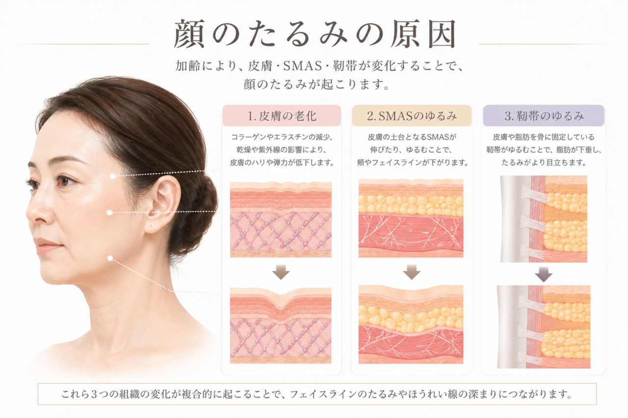 フェイスリフト（切開リフト）