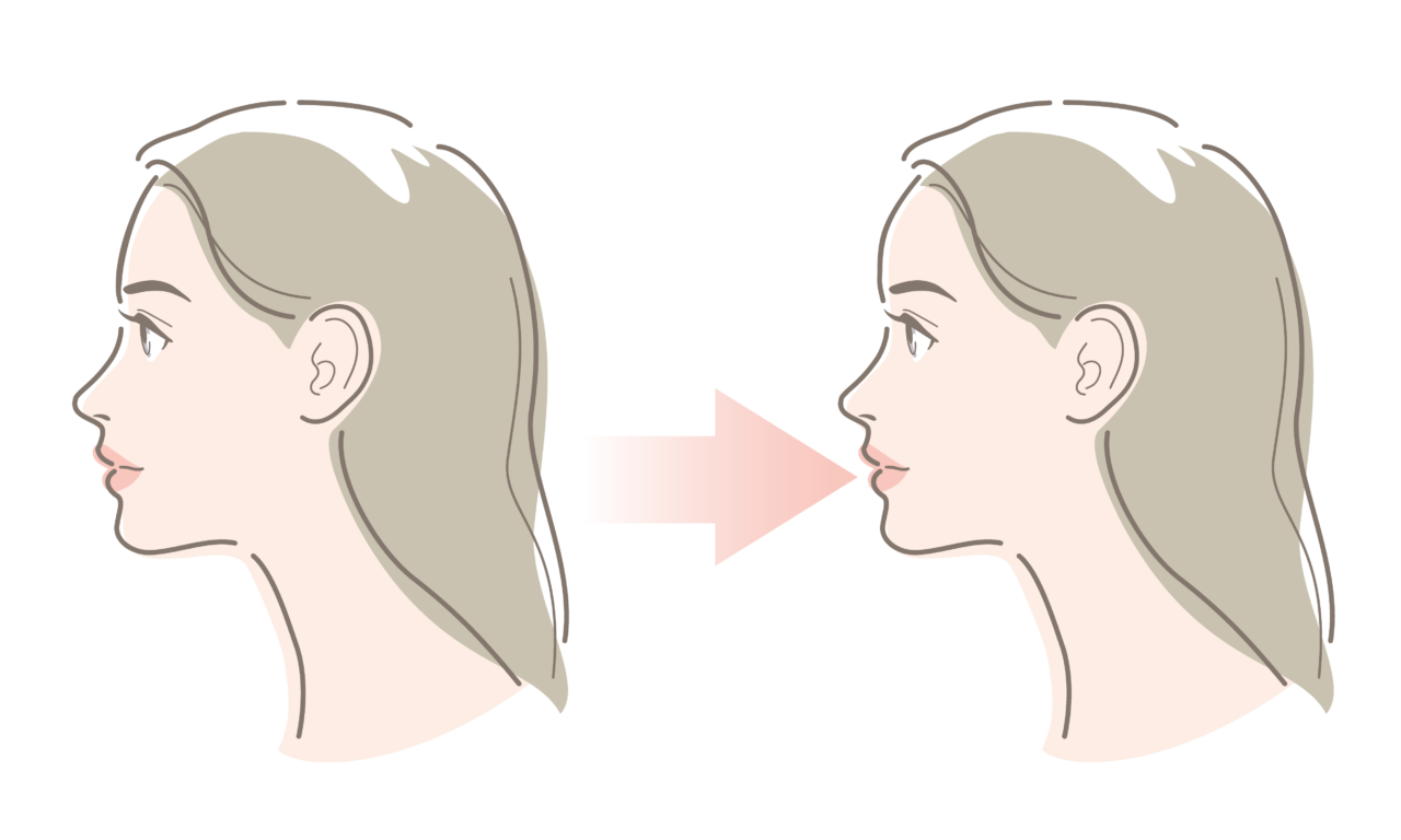 額・こめかみヒアルロン酸