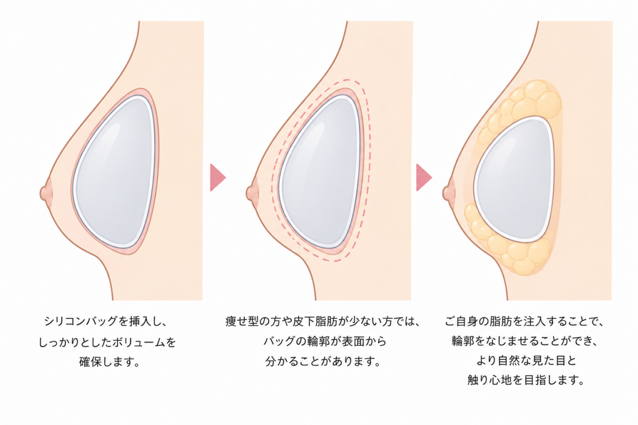 ハイブリッド豊胸