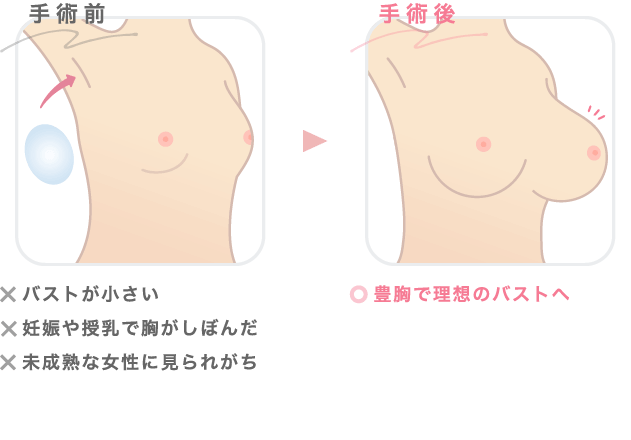 シリコンバッグ豊胸