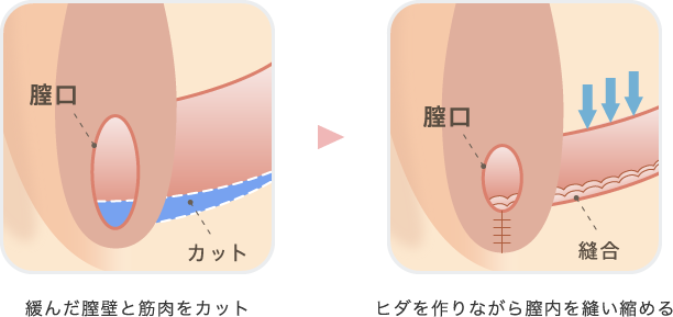 膣縮小
