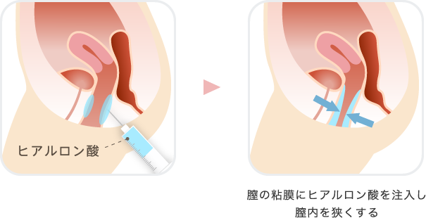 膣縮小