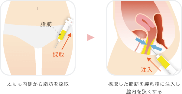 膣縮小