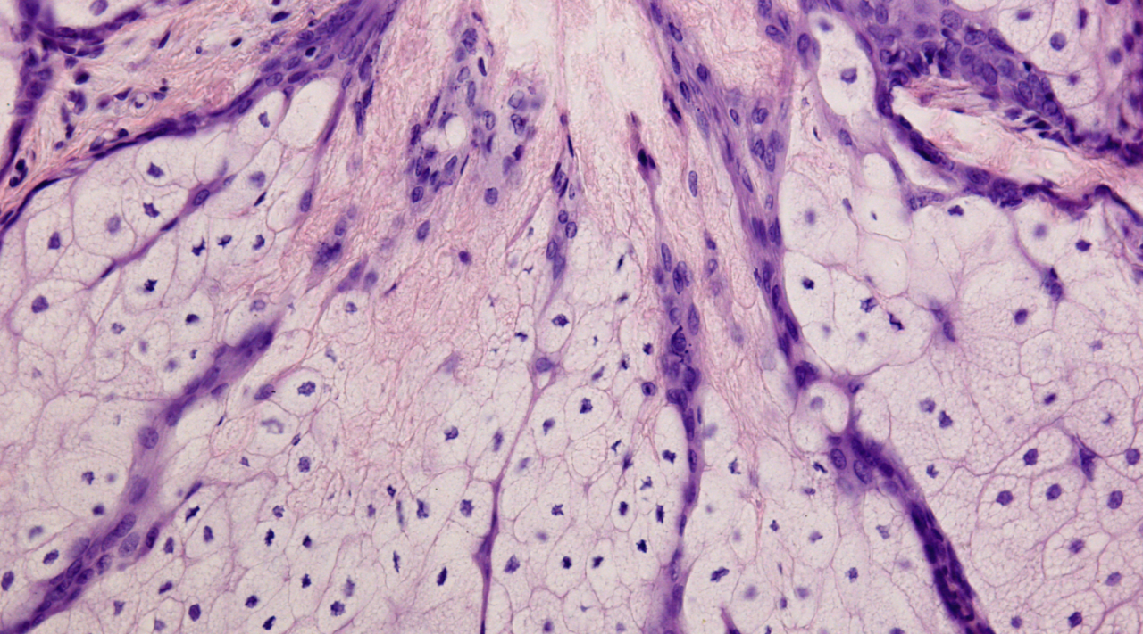 イソトレチノイン内服