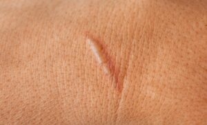 【ケロイド除去】保険適用は？レーザー？手術？あなたに最適な治療法を見つけよう