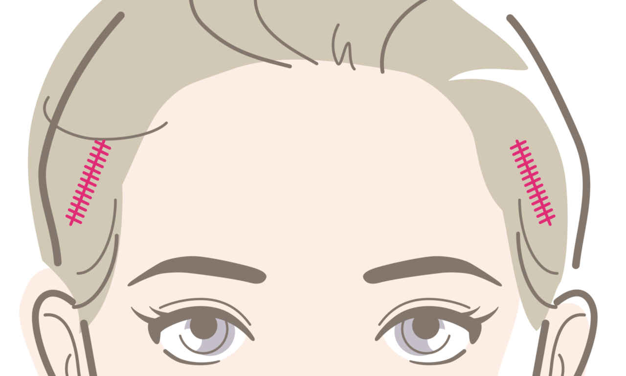 ポニーテールリフト