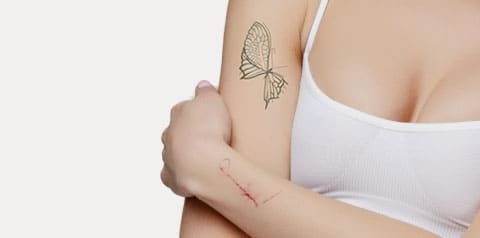 傷跡修正・タトゥー除去