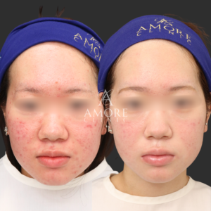 イソトレチノイン20mg