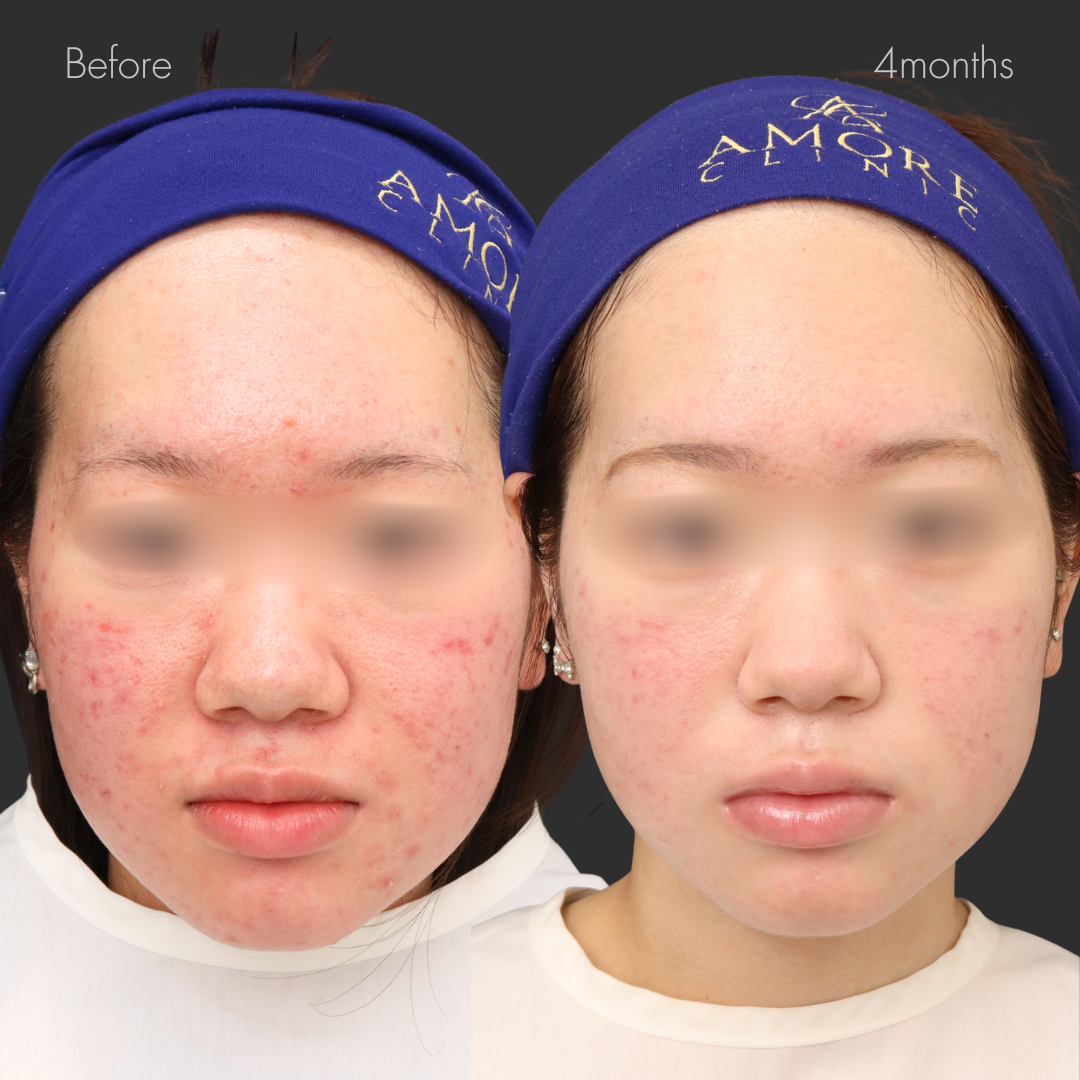 イソトレチノイン20mg