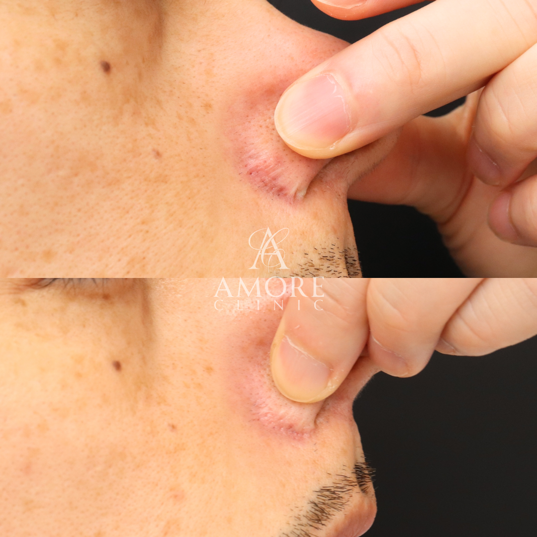 鼻翼縮小後の傷跡修正（グラデーション加工）