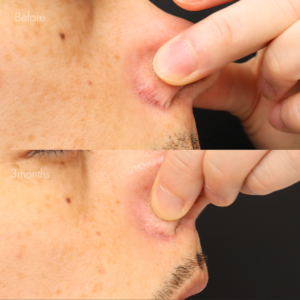 鼻翼縮小後の傷跡修正（グラデーション加工）