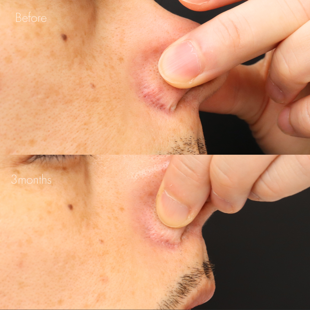 鼻翼縮小後の傷跡修正（グラデーション加工）