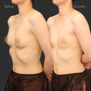  乳腺除去+乳房脂肪除去