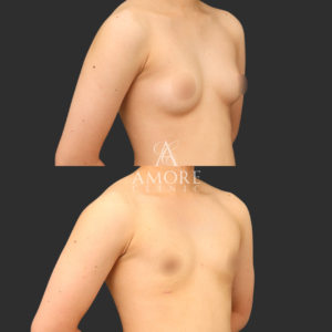  乳腺除去+乳房脂肪除去