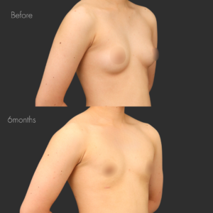  乳腺除去+乳房脂肪除去