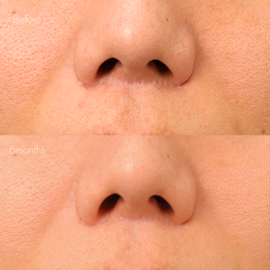 人中短縮後の傷跡修正（グラデーション加工）