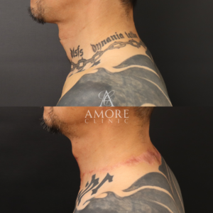 タトゥー除去（切開法）