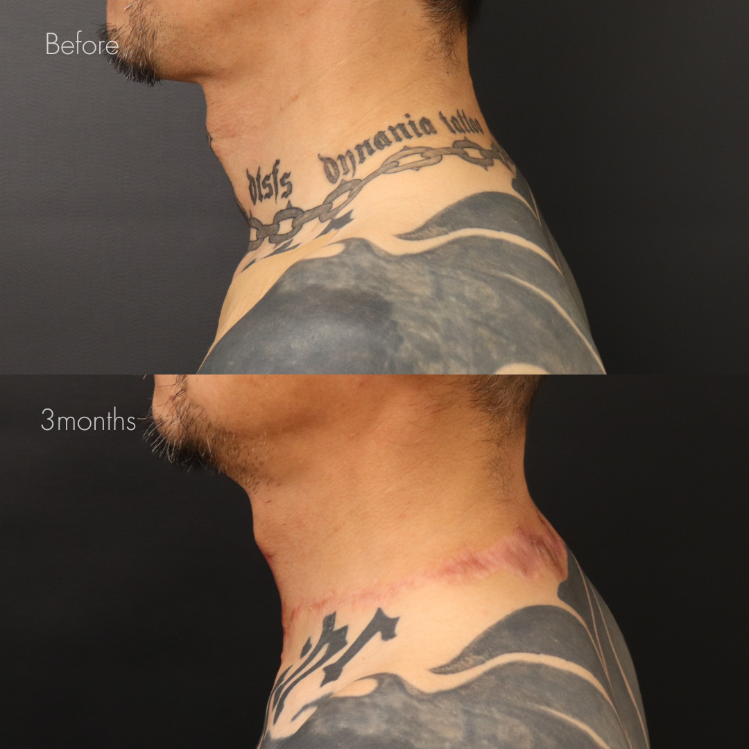 タトゥー除去（切開法）