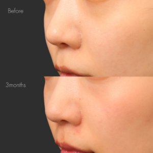 鼻翼縮小後の傷跡修正（グラデーション加工）