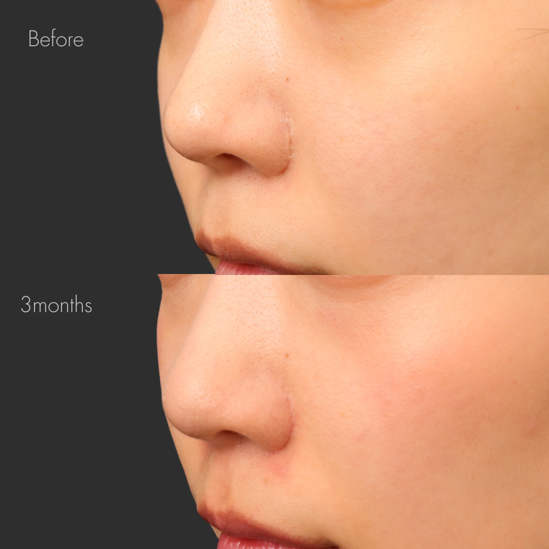 鼻翼縮小後の傷跡修正（グラデーション加工）