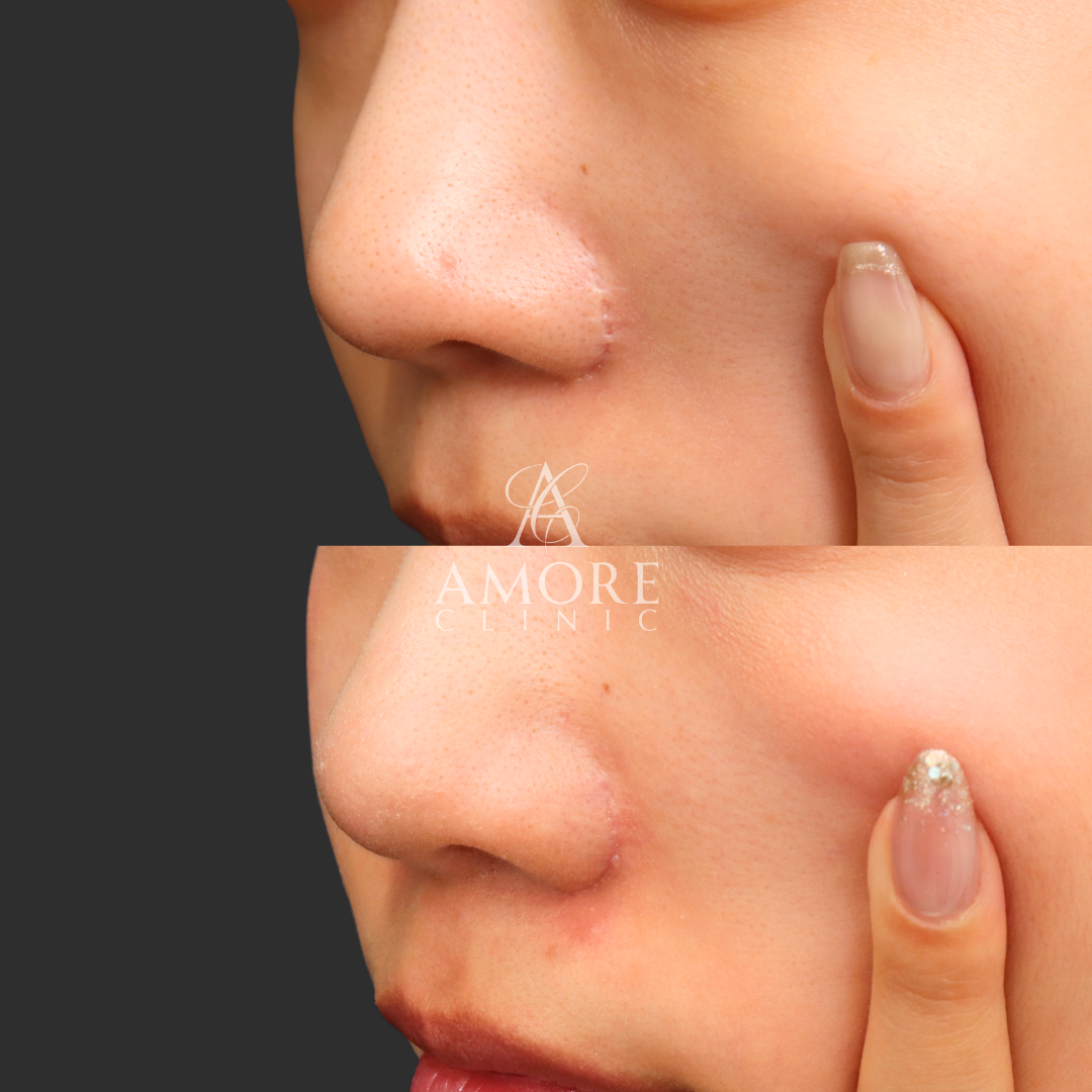 鼻翼縮小後の傷跡修正（グラデーション加工）