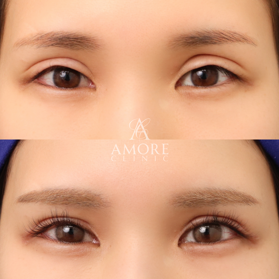 二重全切開（他院修正）＋たるみ除去＋脂肪除去＋癒着解除＋ライン変更