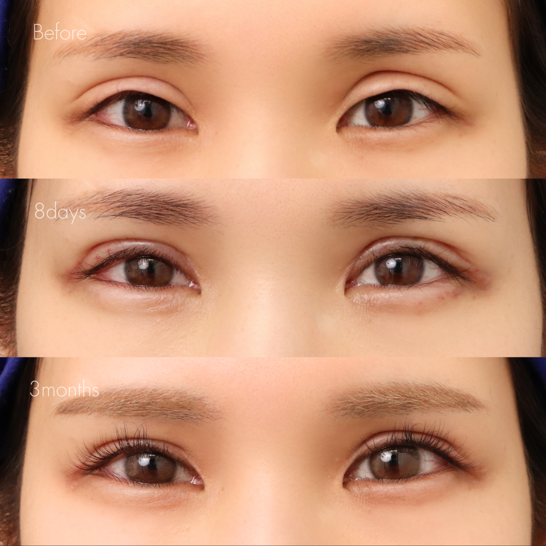 二重全切開（他院修正）＋たるみ除去＋脂肪除去＋癒着解除＋ライン変更