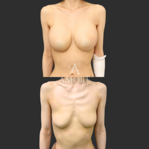 シリコンバッグ豊胸（モティバ500cc）