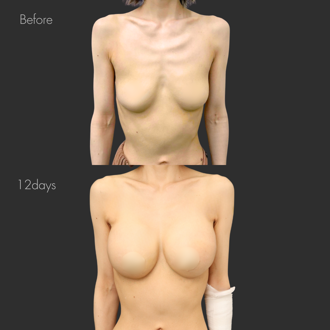 シリコンバッグ豊胸（モティバ500cc）