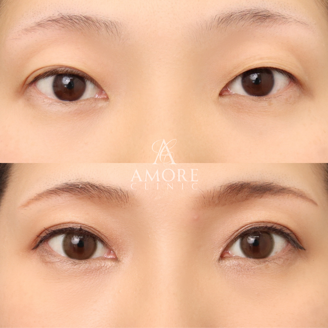 パーフェクト二重術（二重全切開＋たるみ除去＋脂肪除去）＋埋没糸抜去