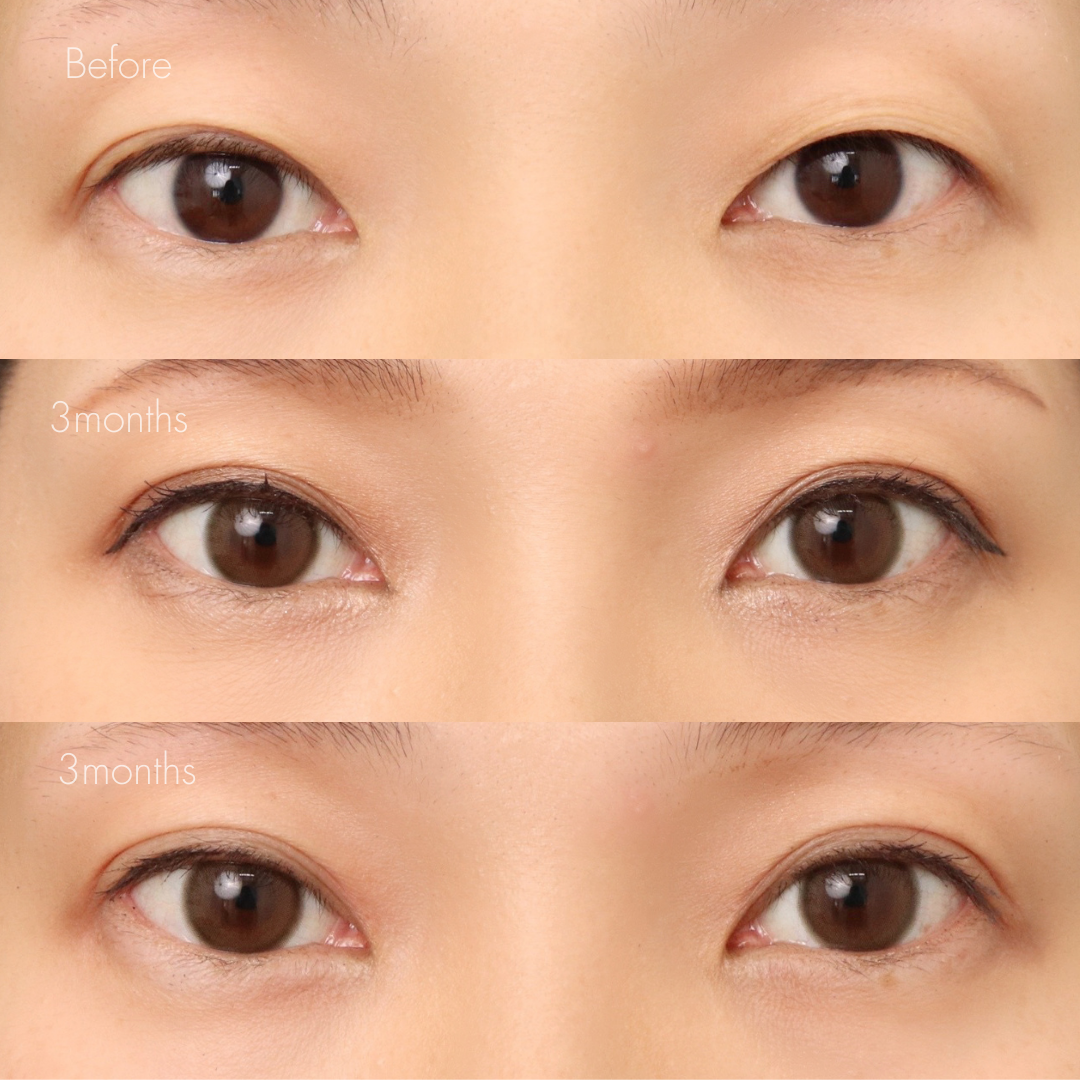 パーフェクト二重術（二重全切開＋たるみ除去＋脂肪除去）＋埋没糸抜去