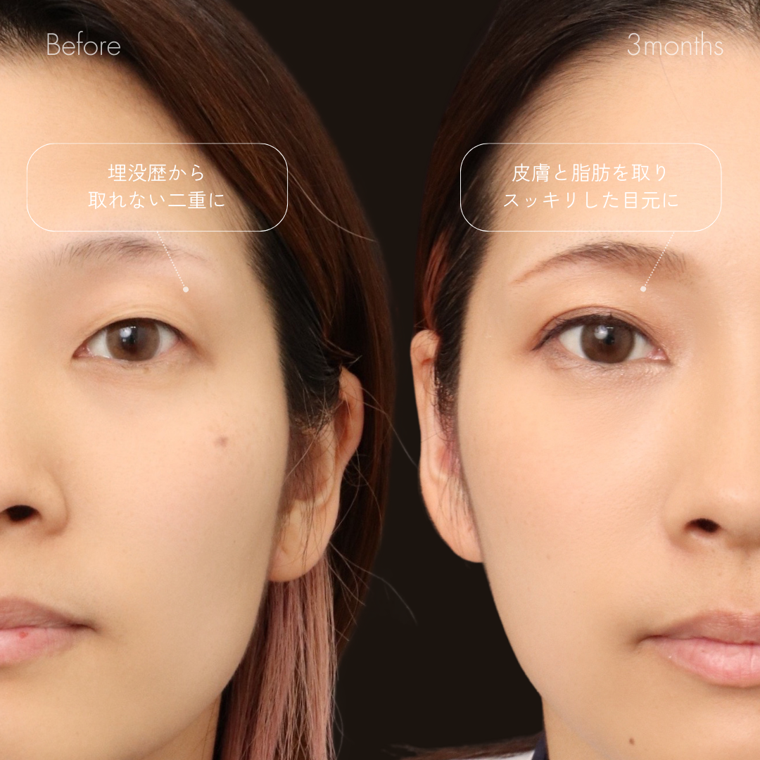 パーフェクト二重術（二重全切開＋たるみ除去＋脂肪除去）＋埋没糸抜去