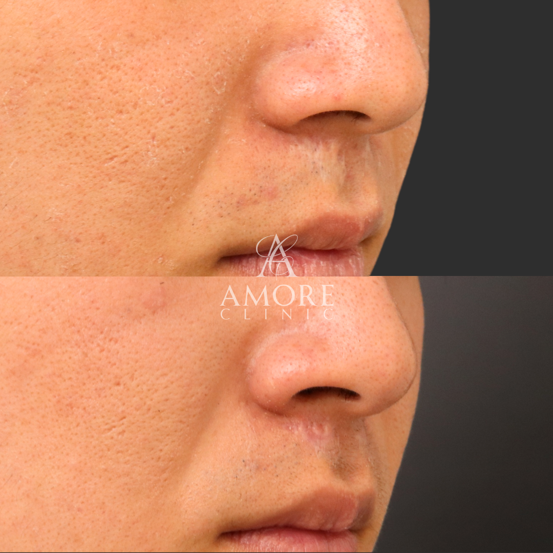 傷跡修正（切開法）