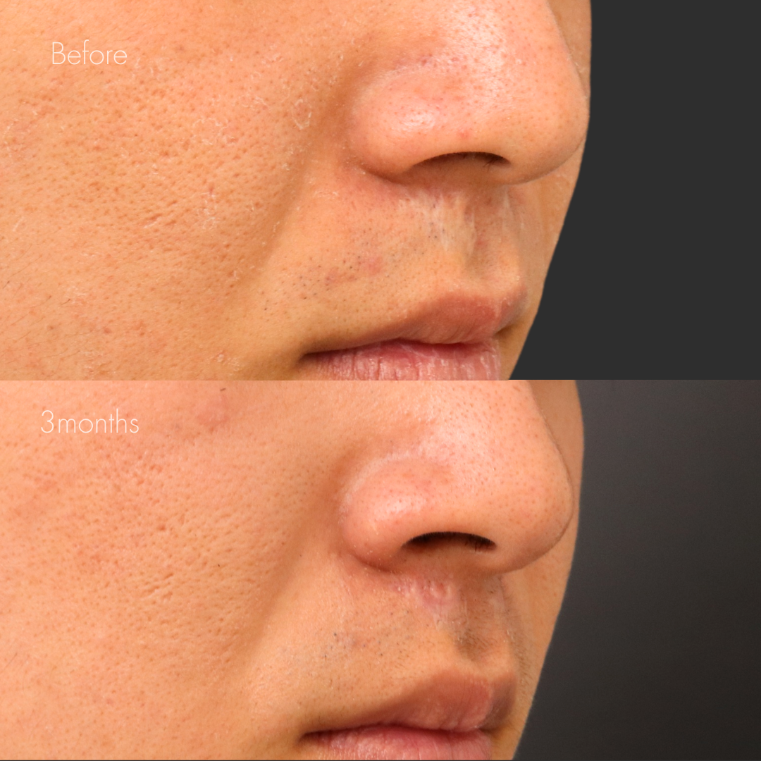 傷跡修正（切開法）