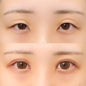 二重全切開（他院修正）＋たるみ除去＋脂肪除去＋ライン変更＋癒着解除＋蒙古ひだ切除