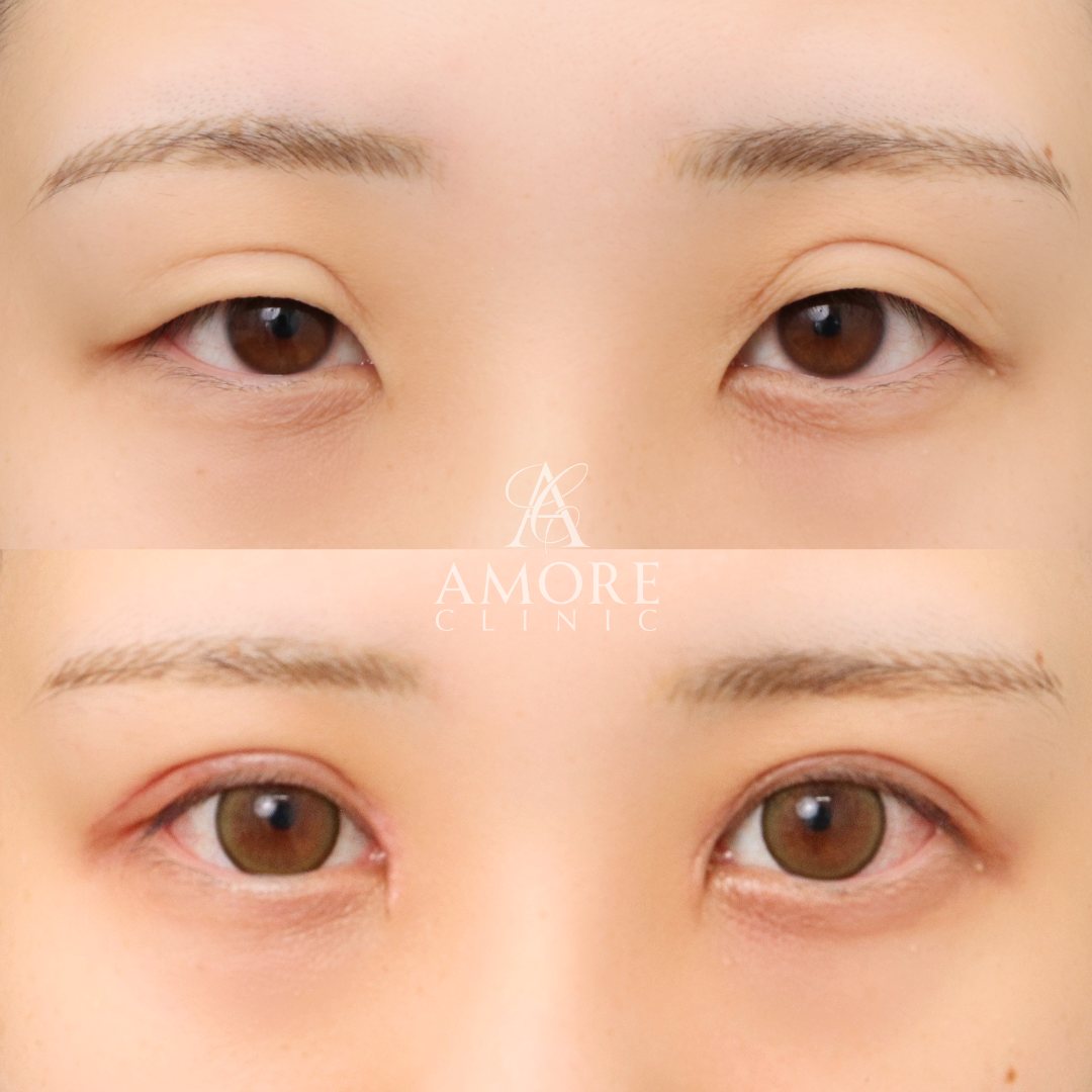 二重全切開（他院修正）＋たるみ除去＋脂肪除去＋ライン変更＋癒着解除＋蒙古ひだ切除