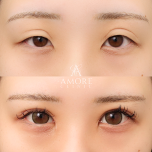 二重全切開（他院修正）＋たるみ除去＋脂肪除去＋ライン変更＋癒着解除＋蒙古ひだ切除