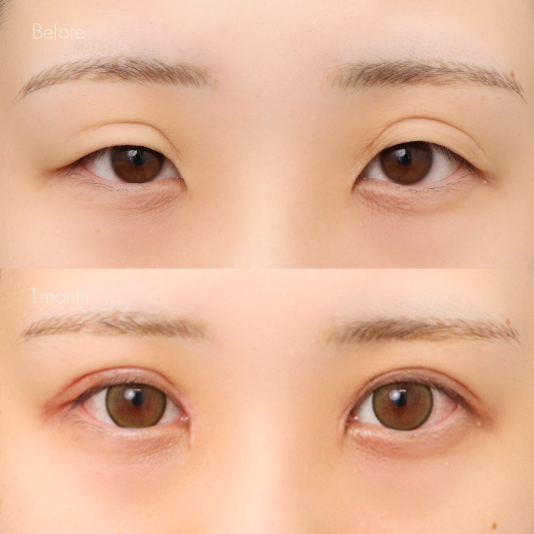 二重全切開（他院修正）＋たるみ除去＋脂肪除去＋ライン変更＋癒着解除＋蒙古ひだ切除