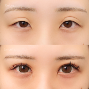 二重全切開（他院修正）＋たるみ除去＋脂肪除去＋ライン変更＋癒着解除＋蒙古ひだ切除