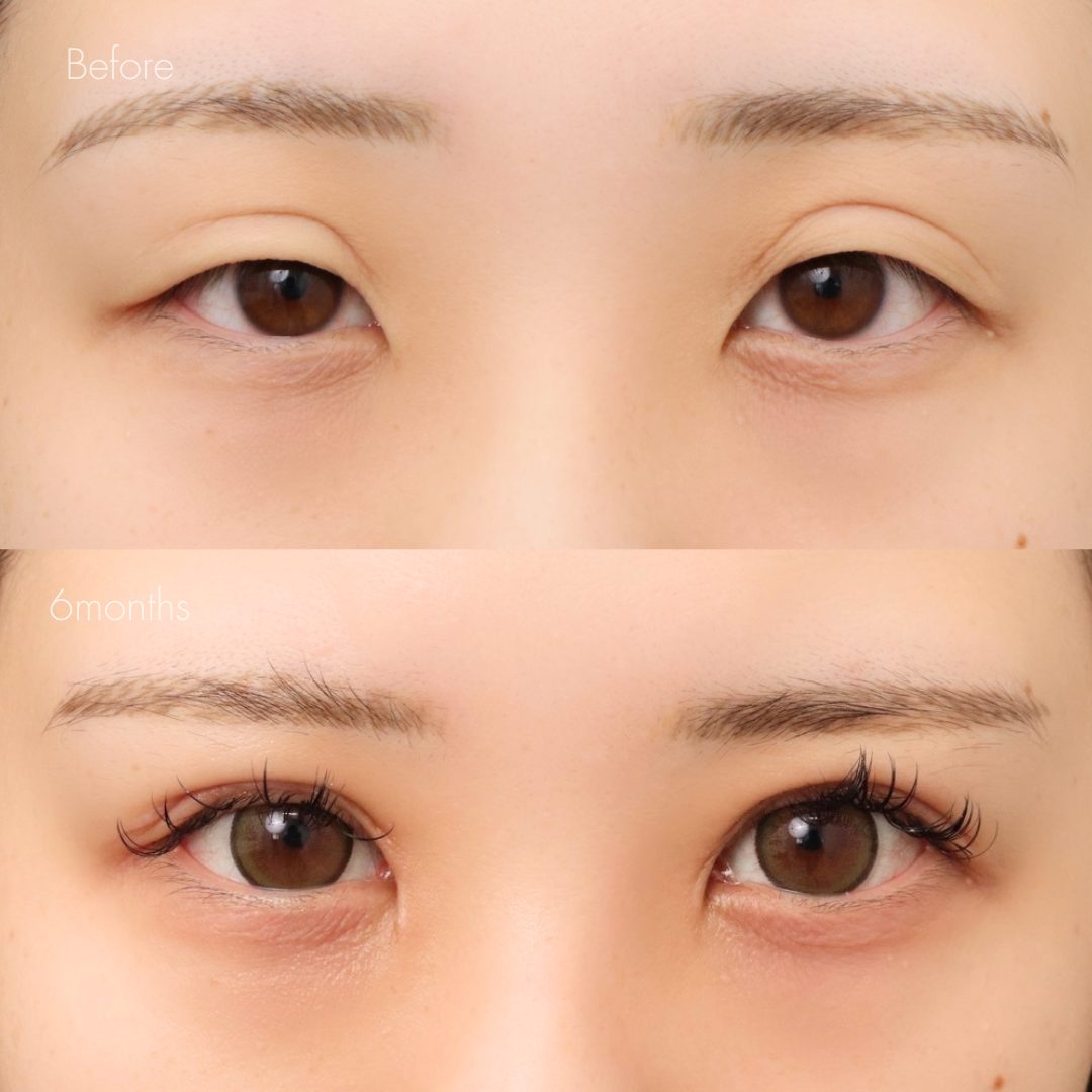 二重全切開（他院修正）＋たるみ除去＋脂肪除去＋ライン変更＋癒着解除＋蒙古ひだ切除