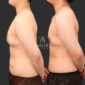  乳腺除去+乳房脂肪除去