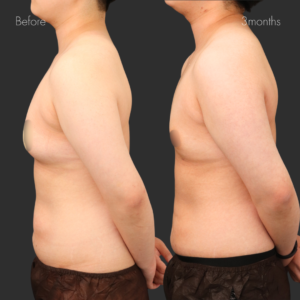  乳腺除去+乳房脂肪除去